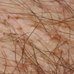 شپش تناسلی (شپش عانه): علائم، درمان